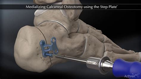 Medializing Calcaneal Osteotomy Using The Step Plate™ Youtube
