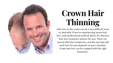 Thin Crown What Do You Recommend For Hair Loss Stages Of Balding