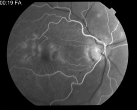 Pattern Dystrophy Simulating Fundus Flavimaculatus 2 Retina Image Bank