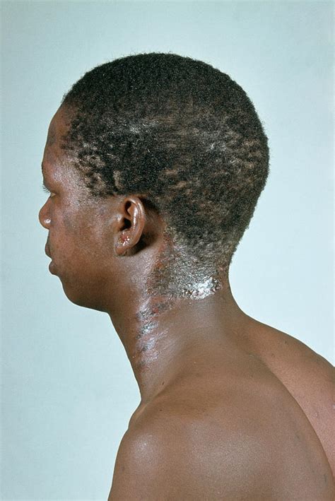 Aids Man With Dermatitis Photograph By Dr Ma Ansaryscience Photo