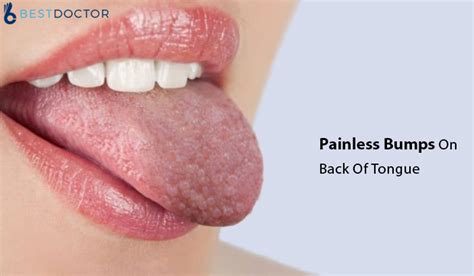 Painless Bumps On Back Of Tongue Causes Treatment Home Remedies