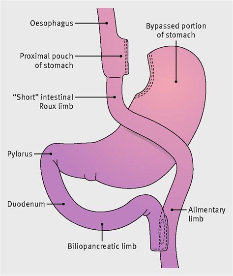 Gastric Bypass Showing Short Vertical Lesser Curve Based Gastric Pouch With Roux En Y Jejuno