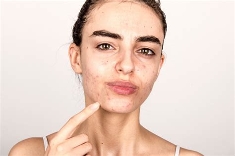 Conoce los tipos y causas del acné Hormonal vulgar quístico