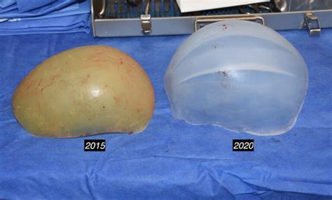 Old Vs New Custom Skull Implant Approach Dr Barry Eppley Indianapolis Explore Plastic Surgery