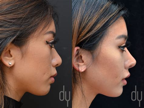 Before And After Revision Asian Rhinoplasty With Rib Cartilage And Dcf