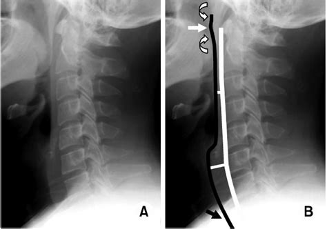 Normal Prevertebral Soft Tissues Normal Lateral Radiographs A B