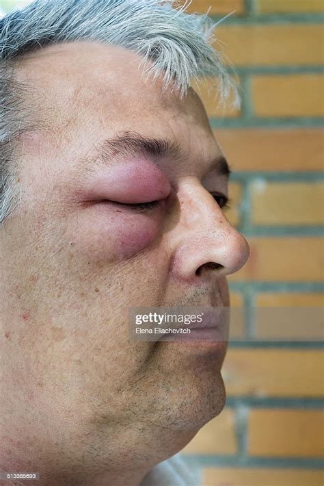 Man With Swollen Eye Photo Getty Images