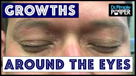 Removing Multiple Different Types Of Growths Around Eyes Youtube