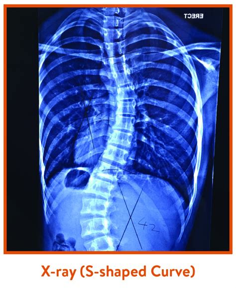 Scoliosis Causes Symptoms And Treatment Zohal