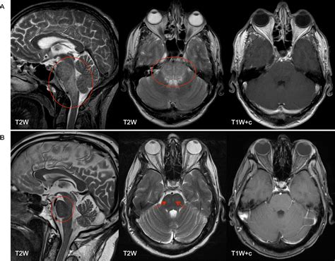 Area Postrema Syndrome As Frequent Feature Of Bickerstaff Brainstem