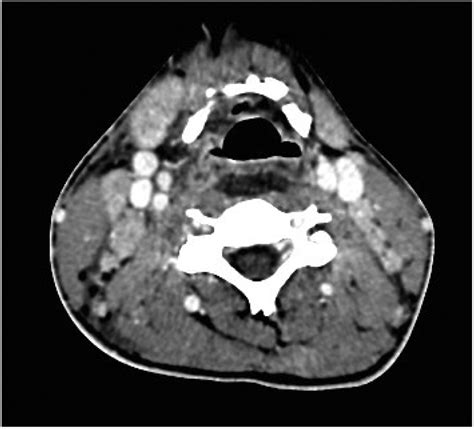Bilateral Reactive Lymph Node Enlargement In Sides Of The Neck
