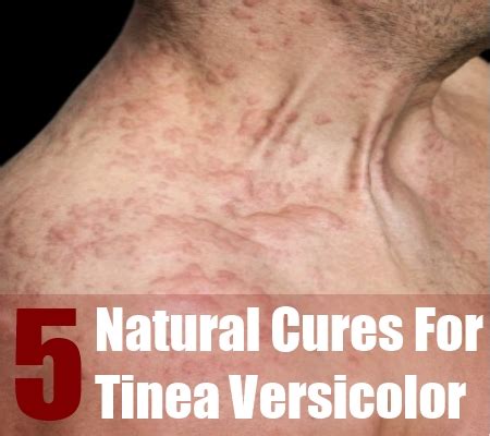But these things can trigger an overgrowth that causes the infection Effective 5 Natural Cures For Tinea Versicolor - Natural ...