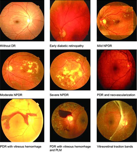 The main stages of diabetic retinopathy are described below. Stages of diabetic retinopathy | Download Scientific Diagram