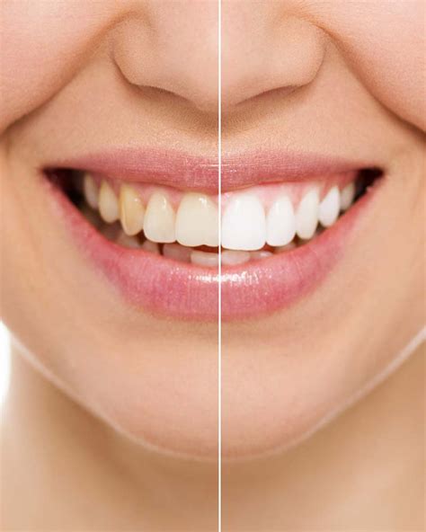 Professional Teeth Whitening In Hassocks Hassocks Dental Surgery