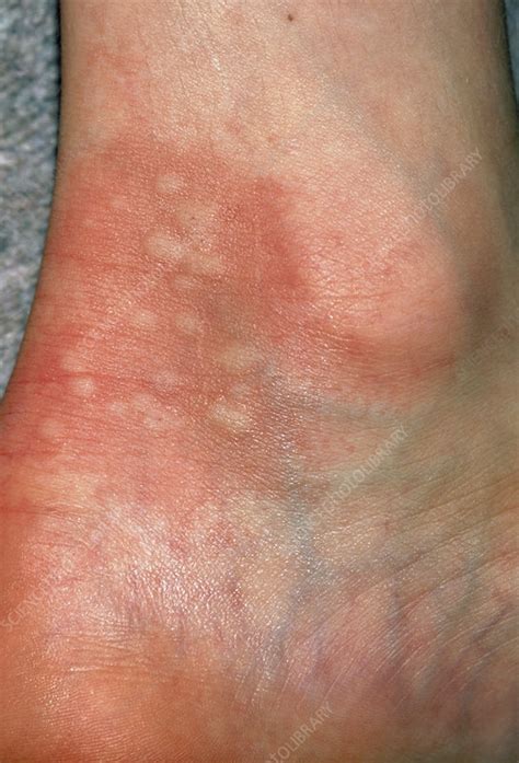 urticaria rash hives on ankle due to nettles stock image m280 0150 science photo library