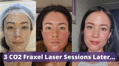 Co2 Fraxel Laser Review 3 Sessions Later Did My Old Atrophic Acne