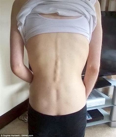 Anorexic Fears Food So Much She Believes Calories Can Be Inhaled