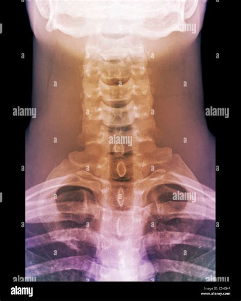 Normal Neck X Ray Hi Res Stock Photography And Images Alamy