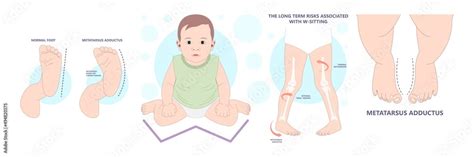 Child W Sit Injury Bow Leg Ankle Pain Genu Valgum Varum Flat Duck Out
