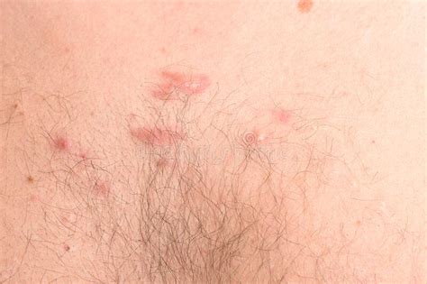 Close Up Before And After Treatment Skin Disease Tinea Versicolor Pityriasis Versicolor Stock