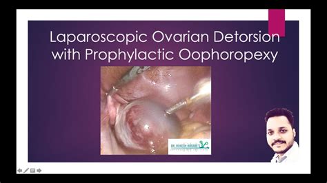 Laparoscopic Ovarian Detorsion With Prophylactic Oophoropexy