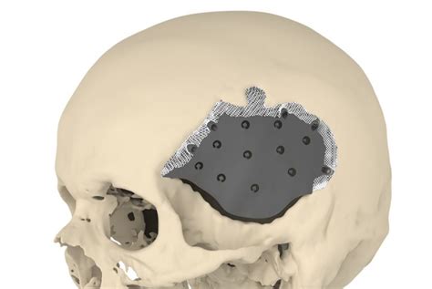 A Novel Implant Enhances Skull Surgery Outcomes Research Outreach