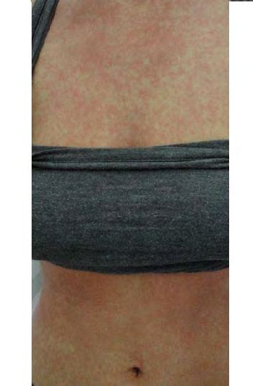 Figure 4 From Drug Rash With Eosinophilia And Systemic Symptoms Dress