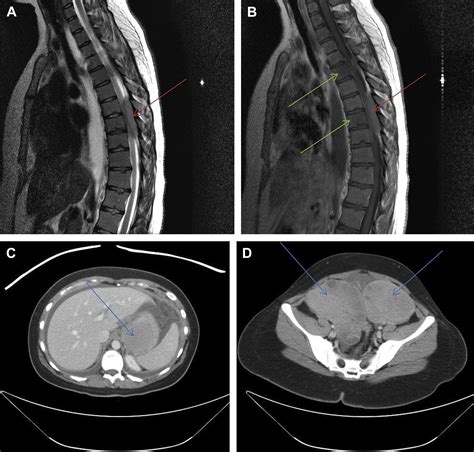 Extranodal Lymphoma Of The Central Nervous System And Spine
