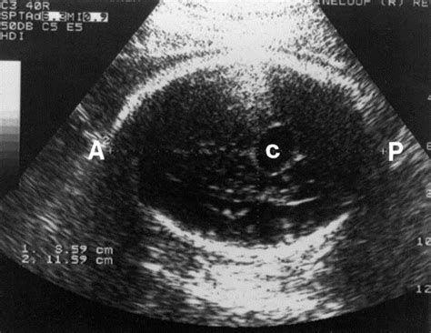 Ultrasonographic Differential Diagnosis Of Fetal Intracranial