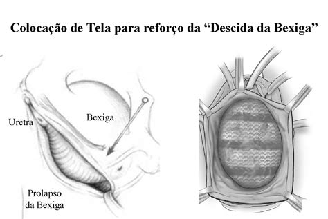 Correção de Prolapsos com Telas Dr Paulo Rodrigues