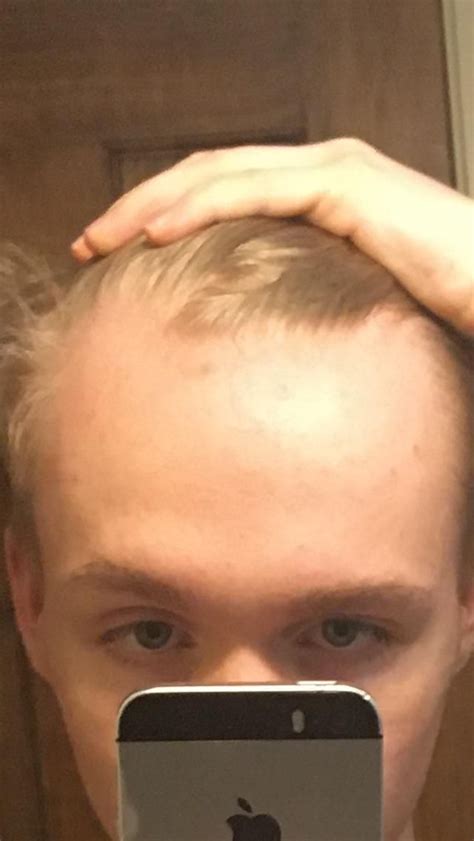 I Have A Severely Receding Hairline At 16 My Hair Is Very Thin And Straight Are There Any