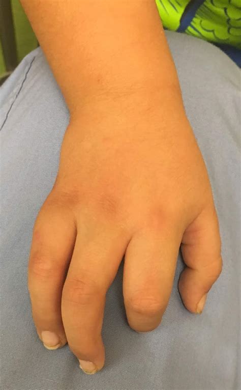 Unusual Extra Finger Congenital Hand And Arm Differences