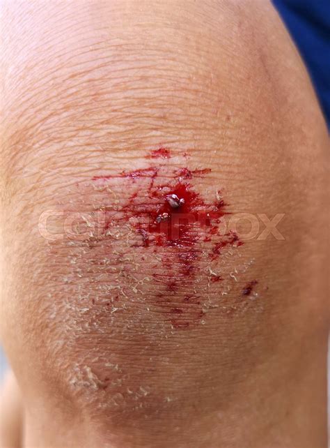 Bloody Bruise Wound On The Knee Stock Image Colourbox