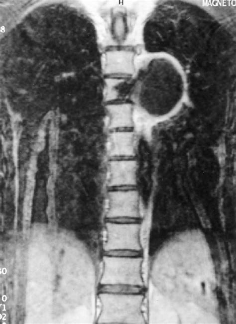 Mri Scan Of The Thoracic Spine Coronal View Showing Clearly The