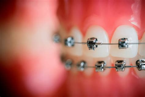 Why Choose Damon Braces Wilmington Orthodontic Center