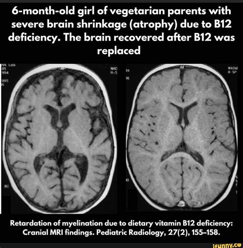 6 Month Old Girl Of Vegetarian Parents With Severe Brain Shrinkage