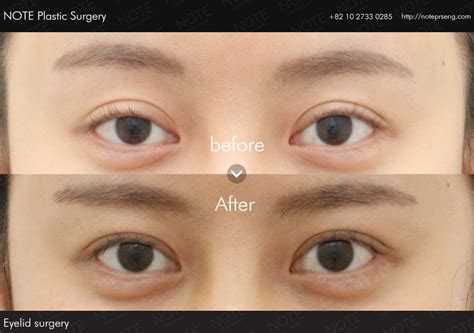 Eyelid Surgery In Korea Before And After Photos Note Plastic