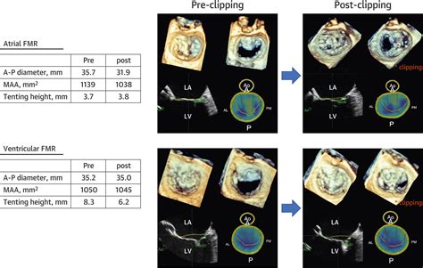 Percutaneous Edge To Edge Repair For Atrial Functional Mitral