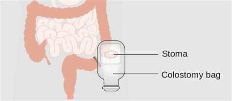 Complications After Colostomy Gastrointestinal Disorders Articles