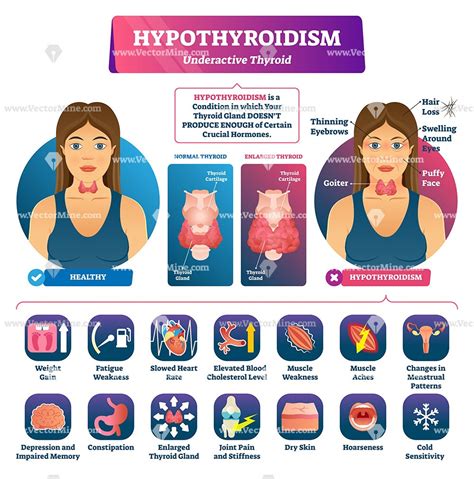 Hypothyroidism Hyperthyroidism Symptoms Checklist