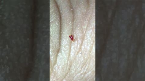 Baby Bed Bug Biting Close Up Youtube
