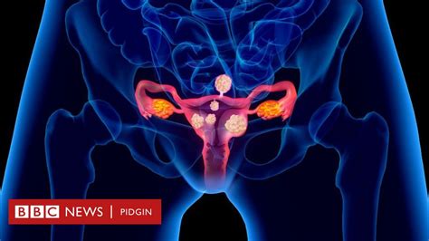Fibroid Eight Shocking Tins Wey Fit Make Woman To Get Dis Tumour For