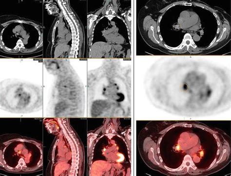 Granulomatous Diseases Radiology Key