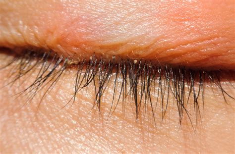 Blepharitis The Low Down On Scaly Itchy Eyelids Mydryeye