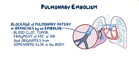 Pulmonary Embolism Clinical Sciences Osmosis Video Library