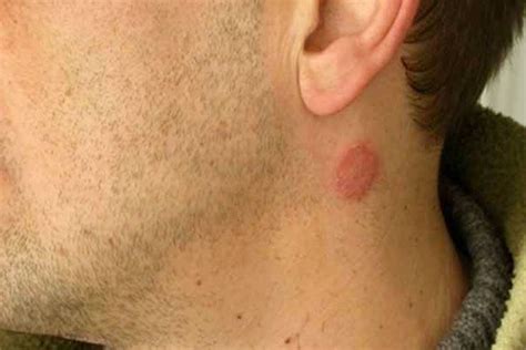 How To Get Rid Of Rash On Neck