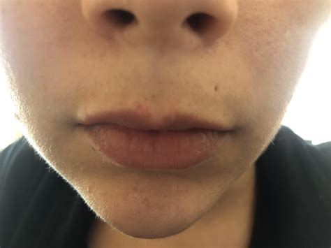 Skin Concerns My Top Lip Skin Is Slowly Disappearing I Get Red Or
