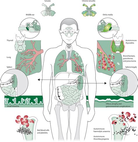 Common Variable Immunodeficiency A New Look At An Old Disease The Lancet