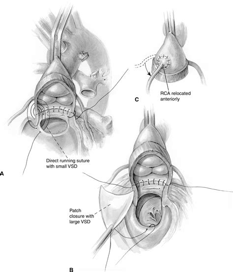 The Aortic Translocation Nikaidoh Operation Operative Techniques In