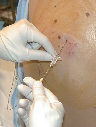 Maybe you would like to learn more about one of these? Women Health and Pregnancy: Epidural Pain Relief (硬膜外麻醉)